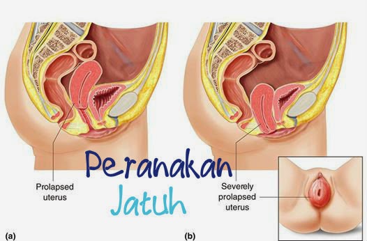 Masalah Peranakan Jatuh