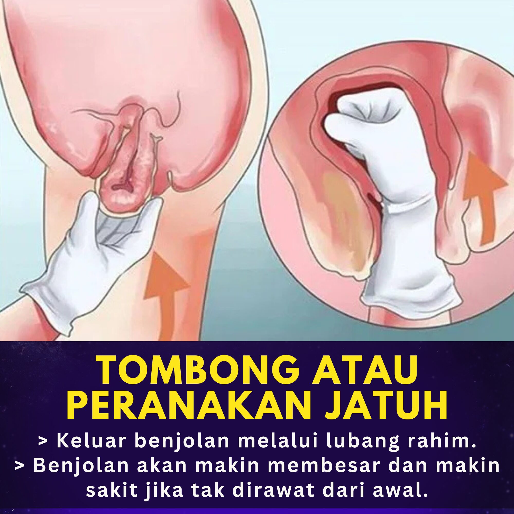 Tombong/ Peranakan Jatuh